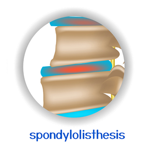 picture of Plainville spondylolisthesis